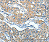 Immunohistochemistry of paraffin-embedded Human lung cancer tissue using SERPINA3 Polyclonal Antibody at dilution 1:55