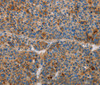 Immunohistochemistry of paraffin-embedded Human liver cancer using AMBP Polyclonal Antibody at dilution of 1:55