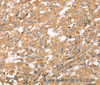 Immunohistochemistry of paraffin-embedded Human thyroid cancer using AHSG Polyclonal Antibody at dilution of 1:60