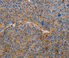 Immunohistochemistry of paraffin-embedded Human liver cancer tissue using AMBRA1 Polyclonal Antibody at dilution 1:50