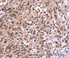 Immunohistochemistry of paraffin-embedded Human esophagus cancer using AMIGO2 Polyclonal Antibody at dilution of 1:50