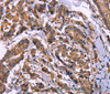 Immunohistochemistry of paraffin-embedded Human breast cancer using AMIGO2 Polyclonal Antibody at dilution of 1:50