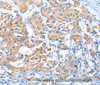 Immunohistochemistry of paraffin-embedded Human lung cancer using AUP1 Polyclonal Antibody at dilution of 1:50