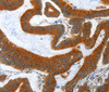 Immunohistochemistry of paraffin-embedded Human colon cancer tissue using ANAPC10 Polyclonal Antibody at dilution 1:40