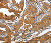 Immunohistochemistry of paraffin-embedded Human lung cancer tissue using ANAPC10 Polyclonal Antibody at dilution 1:40