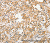 Immunohistochemistry of paraffin-embedded Human thyroid cancer tissue using APC5 Polyclonal Antibody at dilution 1:30