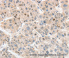 Immunohistochemistry of paraffin-embedded Human liver cancer tissue using APC5 Polyclonal Antibody at dilution 1:30