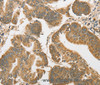 Immunohistochemistry of paraffin-embedded Human colon cancer tissue using ATG3 Polyclonal Antibody at dilution 1:40