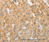 Immunohistochemistry of paraffin-embedded Human liver cancer using ATG5 Polyclonal Antibody at dilution of 1:40