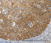 Immunohistochemistry of paraffin-embedded Human cervical cancer tissue using APOBEC3G Polyclonal Antibody at dilution 1:50