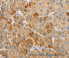 Immunohistochemistry of paraffin-embedded Human liver cancer tissue using APOBEC3G Polyclonal Antibody at dilution 1:50