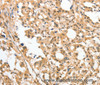Immunohistochemistry of paraffin-embedded Human thyroid cancer tissue using APTX Polyclonal Antibody at dilution 1:50