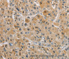 Immunohistochemistry of paraffin-embedded Human liver cancer tissue using NAPSA Polyclonal Antibody at dilution 1:40