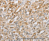 Immunohistochemistry of paraffin-embedded Human thyroid cancer tissue using NAPSA Polyclonal Antibody at dilution 1:40