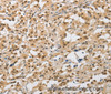 Immunohistochemistry of paraffin-embedded Human thyroid cancer tissue using AMZ2 Polyclonal Antibody at dilution 1:40