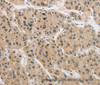Immunohistochemistry of paraffin-embedded Human liver cancer tissue using AMZ2 Polyclonal Antibody at dilution 1:40
