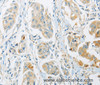 Immunohistochemistry of paraffin-embedded Human breast cancer tissue using ARHGEF10 Polyclonal Antibody at dilution 1:45