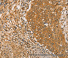 Immunohistochemistry of paraffin-embedded Human cervical cancer tissue using ARMCX3 Polyclonal Antibody at dilution 1:40