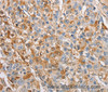 Immunohistochemistry of paraffin-embedded Human liver cancer tissue using IKK gamma Polyclonal Antibody at dilution 1:60