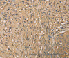 Immunohistochemistry of paraffin-embedded Human cervical cancer tissue using SETD2 Polyclonal Antibody at dilution 1:40