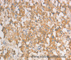Immunohistochemistry of paraffin-embedded Human thyroid cancer tissue using ART3 Polyclonal Antibody at dilution 1:40