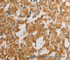 Immunohistochemistry of paraffin-embedded Human thyroid cancer tissue using ATG4D Polyclonal Antibody at dilution 1:40