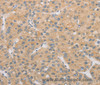 Immunohistochemistry of paraffin-embedded Human liver cancer tissue using ATG4D Polyclonal Antibody at dilution 1:40