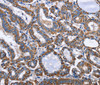 Immunohistochemistry of paraffin-embedded Human thyroid cancer using INTS10 Polyclonal Antibody at dilution of 1:50