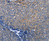 Immunohistochemistry of paraffin-embedded Human cervical cancer using INTS10 Polyclonal Antibody at dilution of 1:50