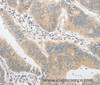 Immunohistochemistry of paraffin-embedded Human colon cancer tissue using CD284 Polyclonal Antibody at dilution 1:40