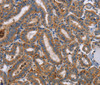 Immunohistochemistry of paraffin-embedded Human thyroid cancer tissue using TLR8 Polyclonal Antibody at dilution 1:40
