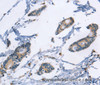 Immunohistochemistry of paraffin-embedded Human colon cancer tissue using TLR8 Polyclonal Antibody at dilution 1:40