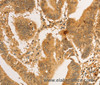 Immunohistochemistry of paraffin-embedded Human colon cancer tissue using RPL26L1 Polyclonal Antibody at dilution 1:30