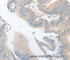 Immunohistochemistry of paraffin-embedded Human colon cancer using EPS15L1 Polyclonal Antibody at dilution of 1:30