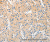 Immunohistochemistry of paraffin-embedded Human liver cancer using RPN1 Polyclonal Antibody at dilution of 1:30