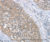 Immunohistochemistry of paraffin-embedded Human cervical cancer tissue using PAPSS1 Polyclonal Antibody at dilution 1:40