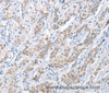 Immunohistochemistry of paraffin-embedded Human gastric cancer tissue using PAPSS1 Polyclonal Antibody at dilution 1:40