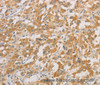 Immunohistochemistry of paraffin-embedded Human thyroid cancer tissue using ZWINT Polyclonal Antibody at dilution 1:50