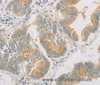 Immunohistochemistry of paraffin-embedded Human colon cancer tissue using ZWINT Polyclonal Antibody at dilution 1:50
