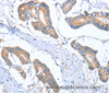 Immunohistochemistry of paraffin-embedded Human colon cancer tissue using MTMR7 Polyclonal Antibody at dilution 1:40