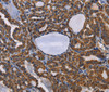 Immunohistochemistry of paraffin-embedded Human thyroid cancer tissue using GRK3 Polyclonal Antibody at dilution 1:50