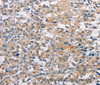 Immunohistochemistry of paraffin-embedded Human thyroid cancer using PKC epsilon Polyclonal Antibody at dilution of 1:50