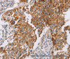 Immunohistochemistry of paraffin-embedded Human lung cancer tissue using GUCY1A3 Polyclonal Antibody at dilution 1:40