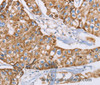 Immunohistochemistry of paraffin-embedded Human breast cancer tissue using GUCY1A3 Polyclonal Antibody at dilution 1:40