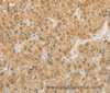 Immunohistochemistry of paraffin-embedded Human liver cancer using PGK2 Polyclonal Antibody at dilution of 1:50