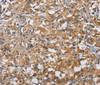 Immunohistochemistry of paraffin-embedded Human thyroid cancer tissue using PIKFYVE Polyclonal Antibody at dilution 1:50