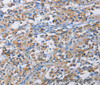 Immunohistochemistry of paraffin-embedded Human thyroid cancer tissue using RICTOR Polyclonal Antibody at dilution 1:50