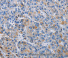 Immunohistochemistry of paraffin-embedded Human liver cancer tissue using RICTOR Polyclonal Antibody at dilution 1:50