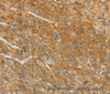 Immunohistochemistry of paraffin-embedded Human liver cancer tissue using VTN Polyclonal Antibody at dilution 1:40