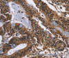 Immunohistochemistry of paraffin-embedded Human colon cancer tissue using EPHB6 Polyclonal Antibody at dilution 1:50